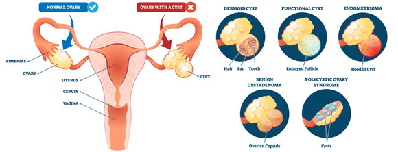 Cystectomy (Ovarian Cysts Removal)